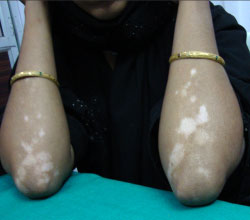 Leucoderma before and after